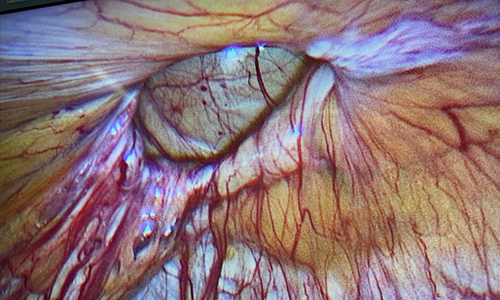 Fıtık İçeriği Olan Omentumun Karın İçine Çekilmesi