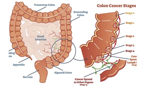 Kolorektal Kanser Evreleri