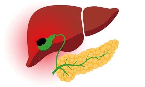 Gangrenöz Kolesistit Nedir? Nedenleri Nelerdir?