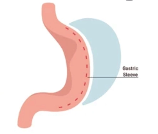 Tüp Mide Ameliyatı (Sleeve Gastrektomi) Aşama: Üçüncü Adım