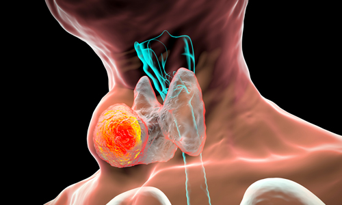 Tiroid Nodülü Nedir?